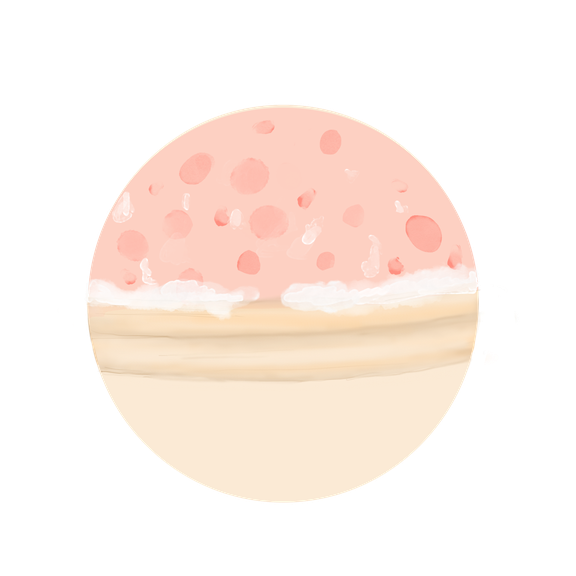 Die Illustration zeigt die Reaktion der Haut eines Mannes der von der Balanitis betroffen ist. 