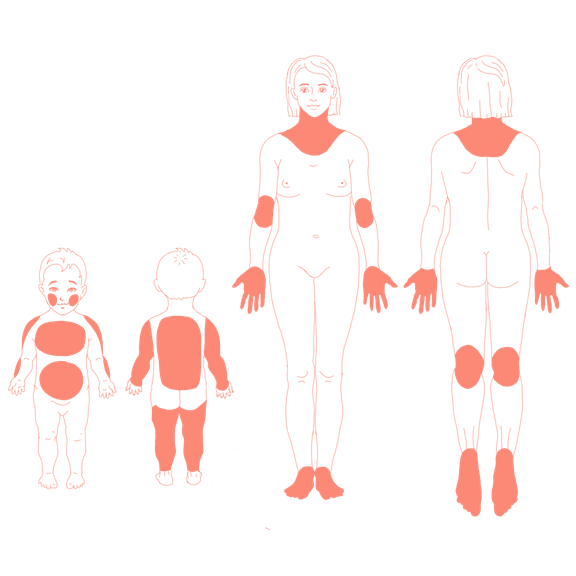 Illustration der betroffenen Hautstellen bei der atopischen Dermatitis (Neurodermitis)