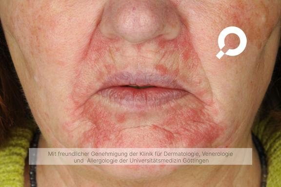 Periorale Dermatitis