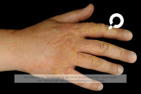 Irritativ-toxische Dermatitis (toxische Kontaktdermatitis)