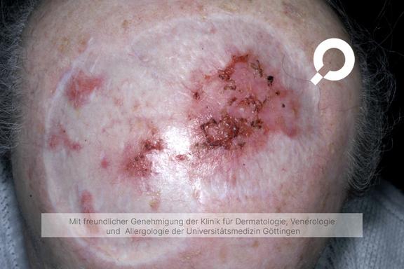 Dermatosis praecancerosa (Morbus Bowen)