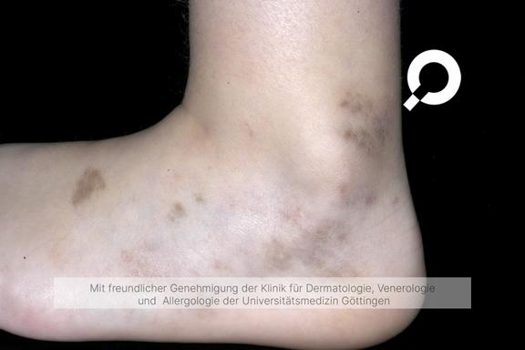 Pigmentflecken (Hyperpigmentierung)