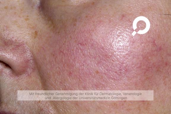 Rosacea (Rosazea)