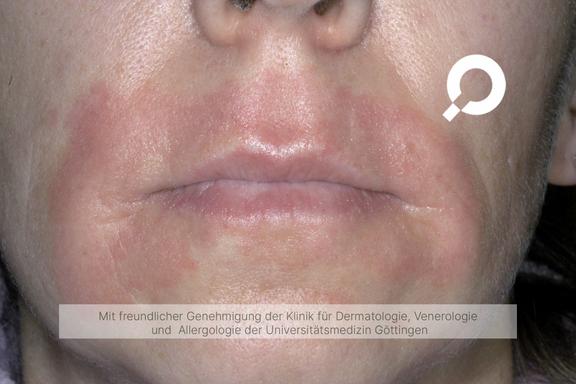 Periorale Dermatitis