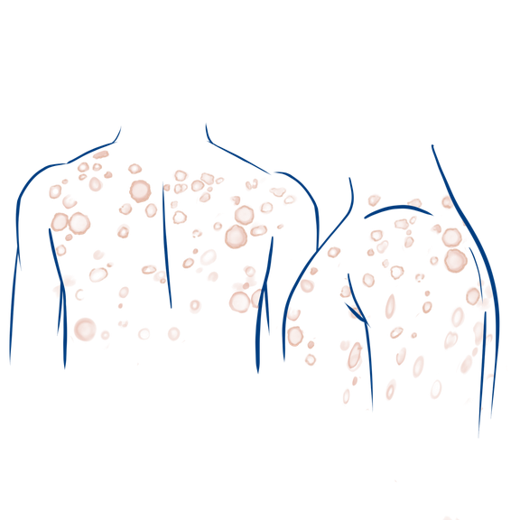 Symptome bei Granuloma Annulare Erkrankungen