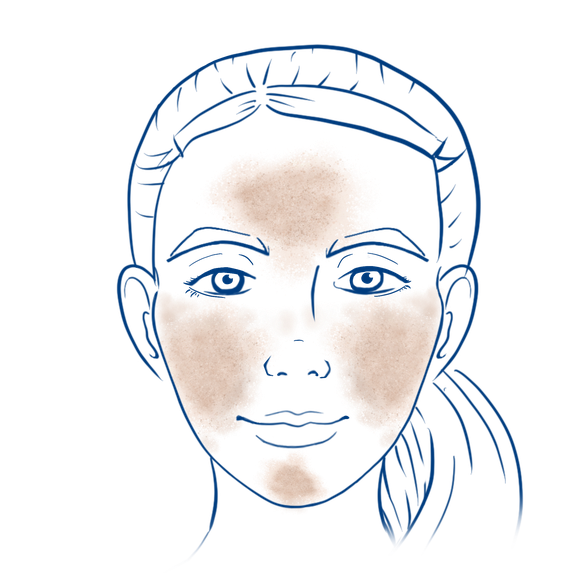 Malasma Illustration - Symptome und Lokalisation