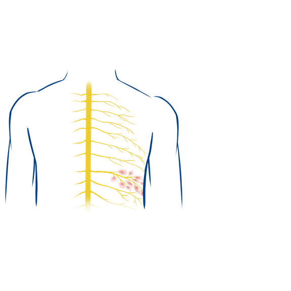 Illustration zur Ursaache von Herpes Zoster