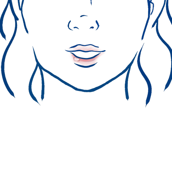 Illustration einer Aphte im Mundbereich