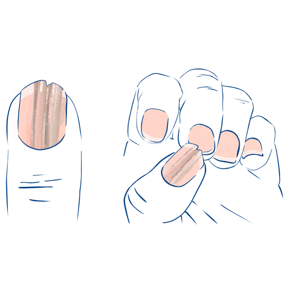 Illustration der Symptome bei Melanochia Striate