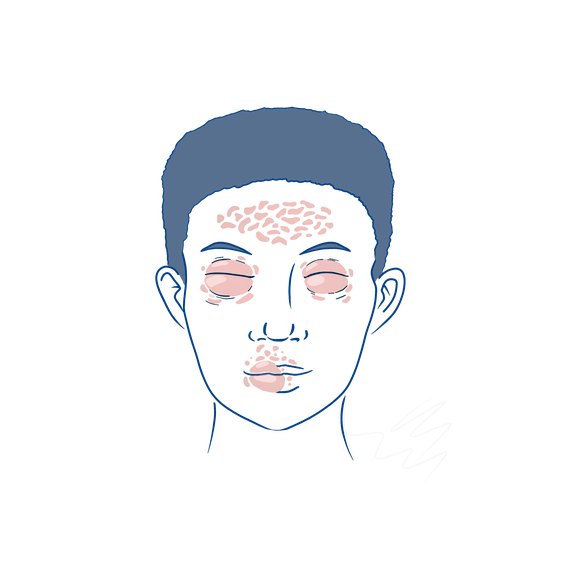 Illustration eines ausgeprägten Angioödem