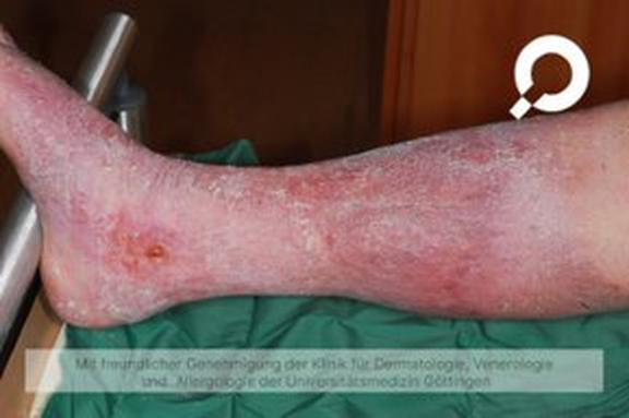 Stauungsdermatitis