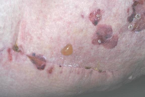 Dermatitis herpetiformis Duhring