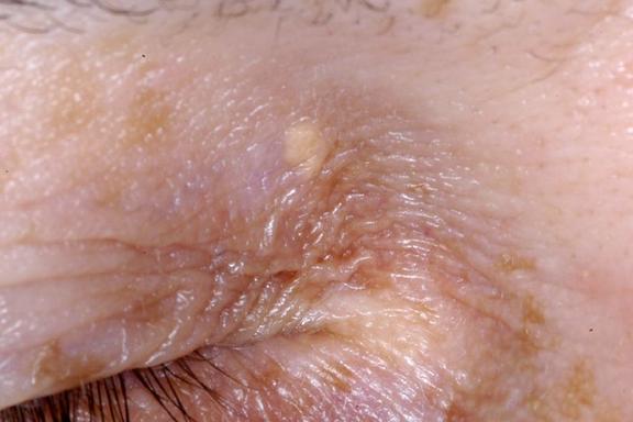 Xanthelasma
