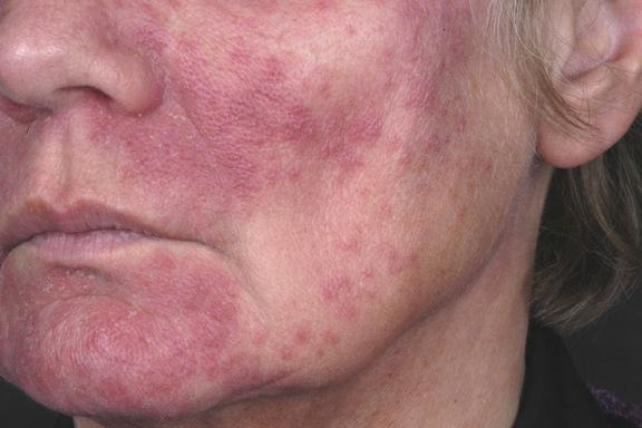 Periorale Dermatitis