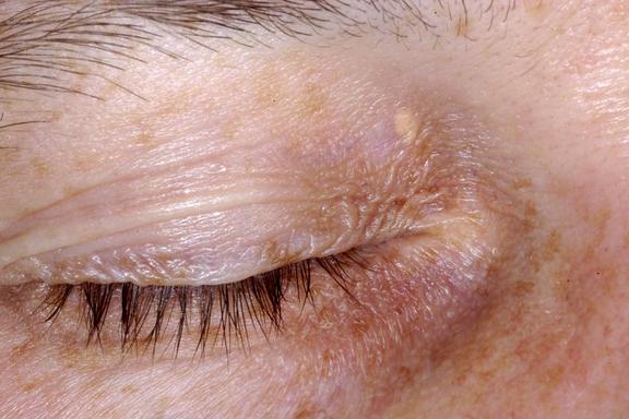 Xanthelasma