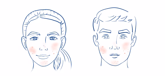 Periorale Dermatitis 